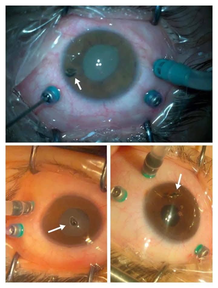 أشعات خاصة بالمرضى الثلاثة