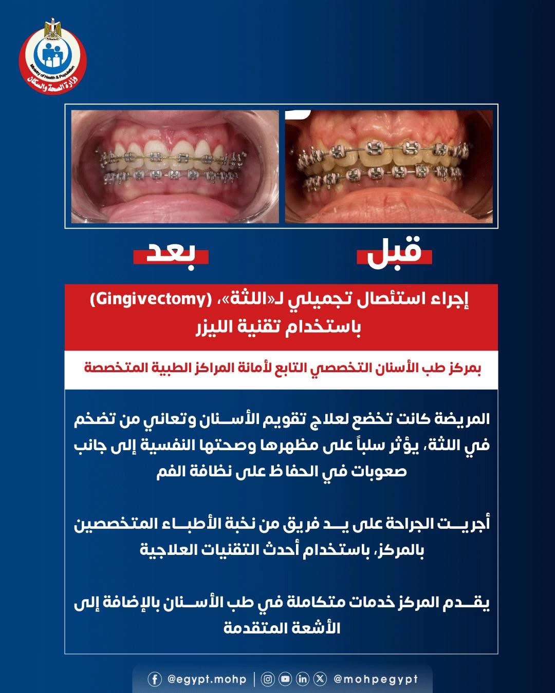 وزارة الصحة إجراء استئصال تجميلي لـ«اللثة»باستخدام تقنية الليزر وزارة الصحة إجراء استئصال تجميلي لـ«اللثة»باستخدام تقنية الليزر