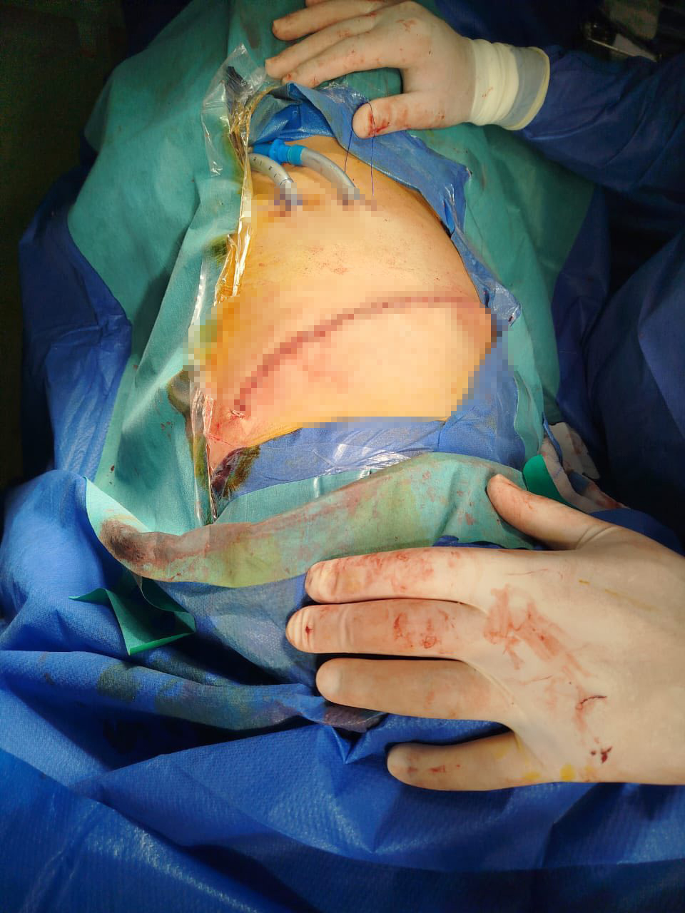 بعد الجراحة