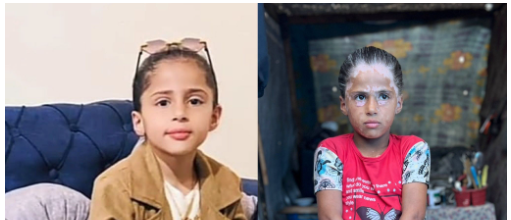 لانا الشريف قبل وبعد إثابتها بالبهاق