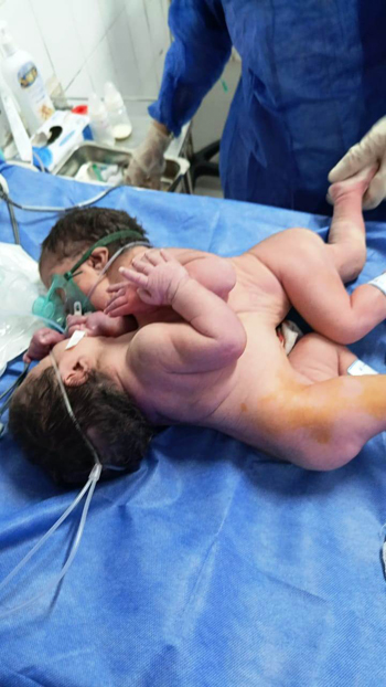 ولادة نادرة لتوأم ملتصق بمستشفى الفيوم العام ولادة نادرة لتوأم ملتصق بمستشفى الفيوم العام