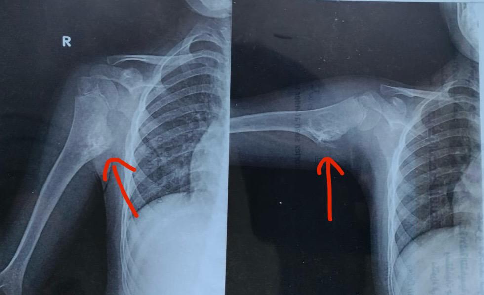 تحديد مكان الورم 