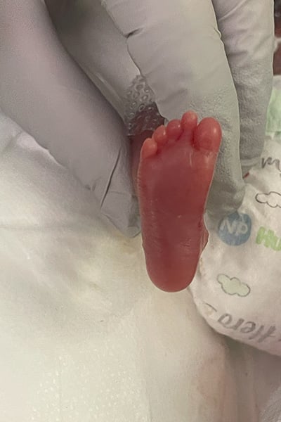 nash-keen-most-premature-baby-closeup-of-foot-after-being-delivered