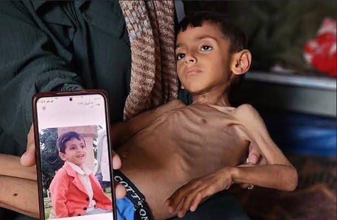 طفل فلسطينى قبل وبعد تعرضه لآلم الجوع