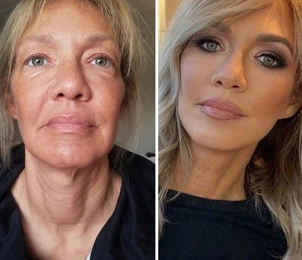 نقل الدهون وشد الوجه نقل الدهون وشد الوجه