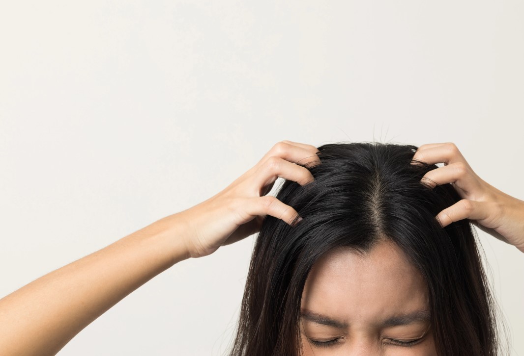 الإنزعاج من حب شباب فروة الرأس