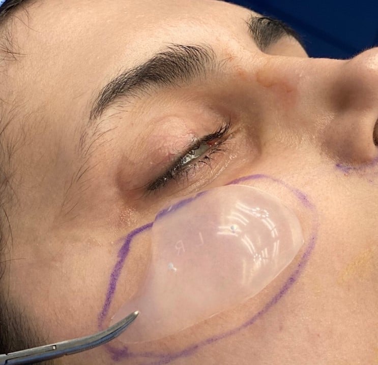 زرع الخدين زرع الخدين