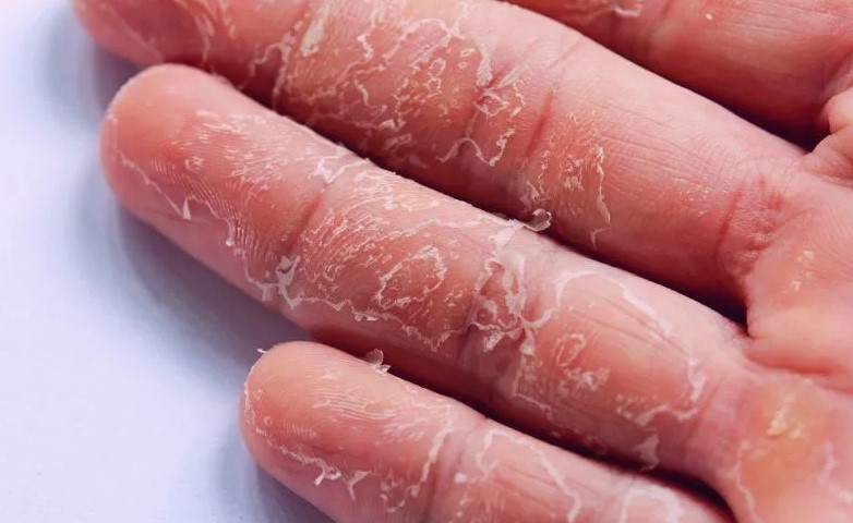 وصفات طبيعية لعلاج تقشر اليدين