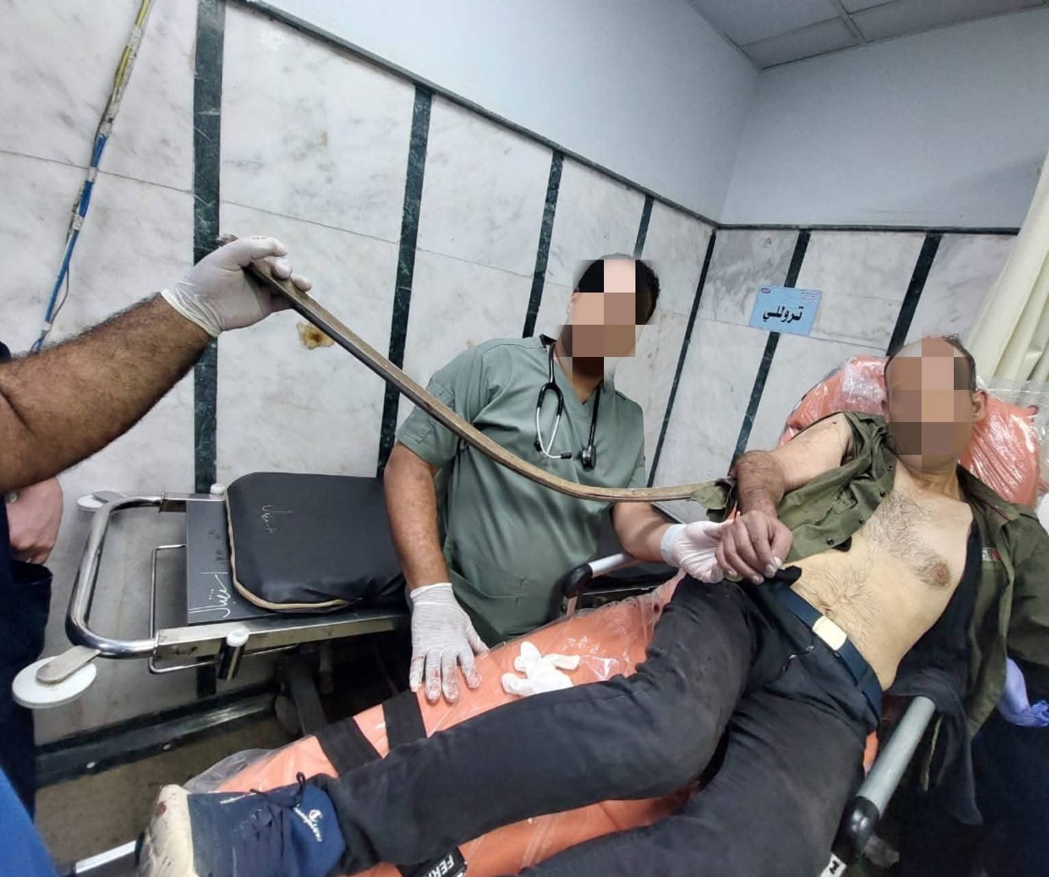 السيخ الحديدي قبل نزعه من ذراع المريض