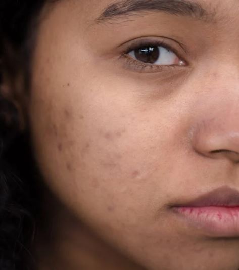 التخلص من اثار الحبوب