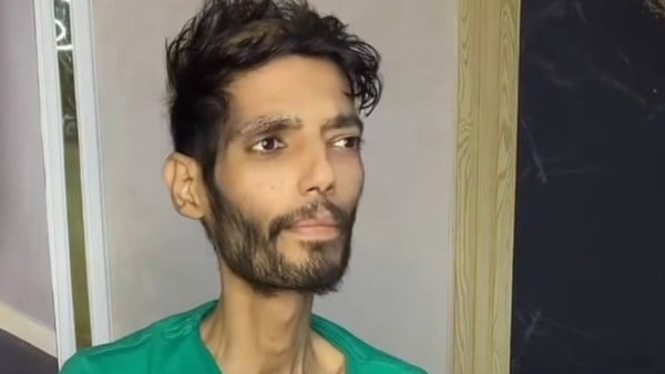 تحول شكل ابراهيم شيكا بعد مرضه تحول شكل ابراهيم شيكا بعد مرضه