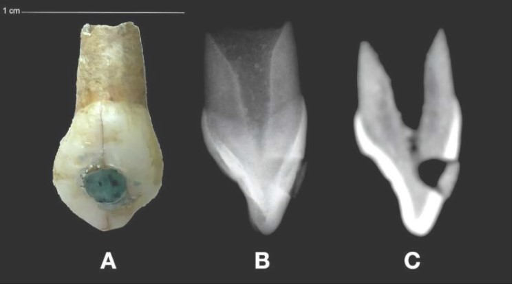 حشو الأسنان