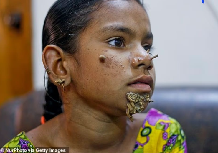 متلازمة الرجل الشجرة 2