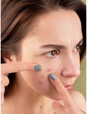 نصائح العناية بالبشرة في حب الشباب