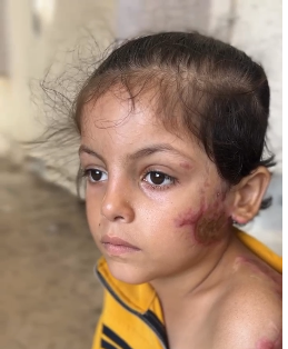 الاحتلال يشوه وجهه الطفلة جود ماضي