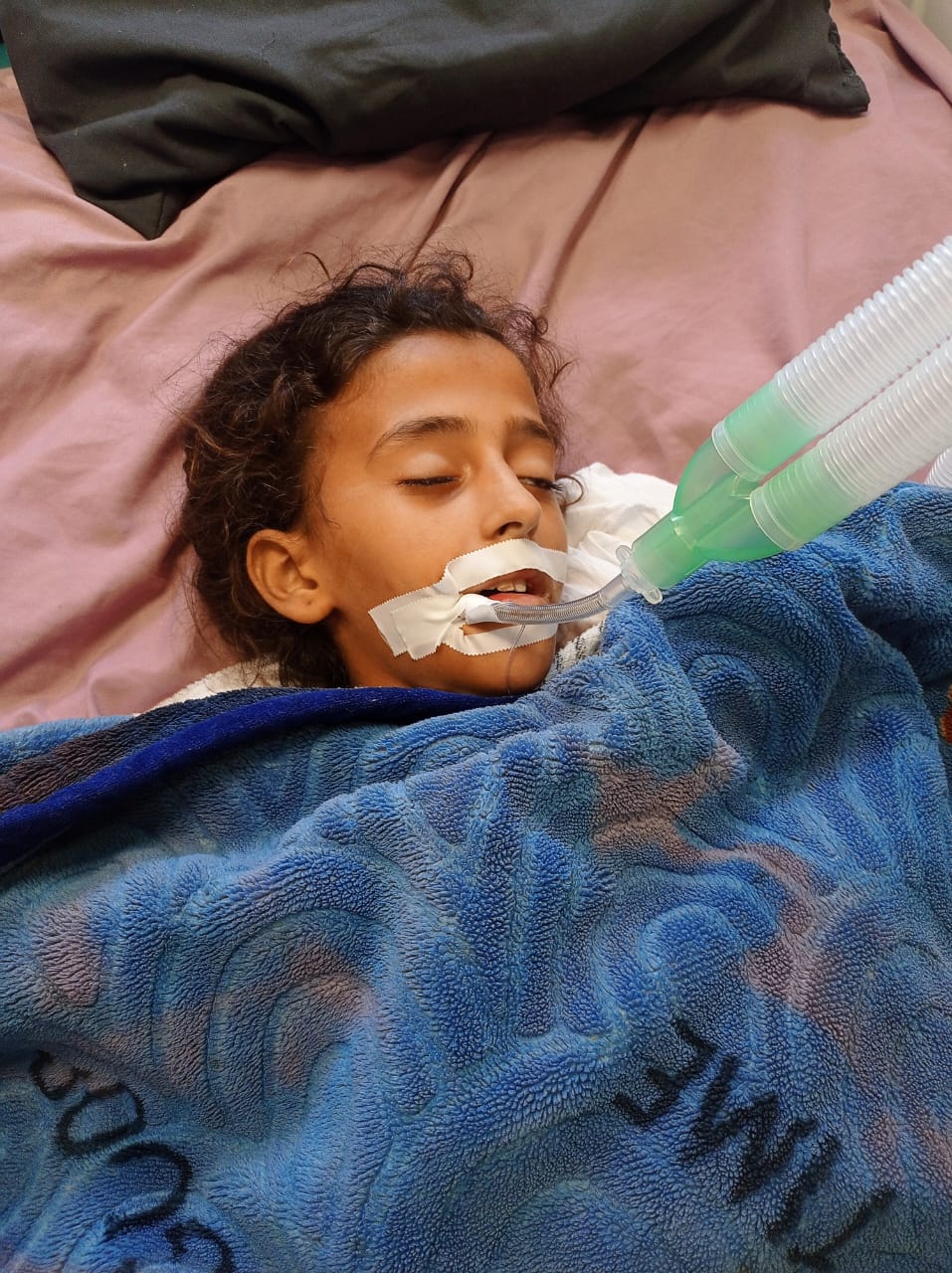 الطفلة سبين سليم النجار   بعد الإصابة