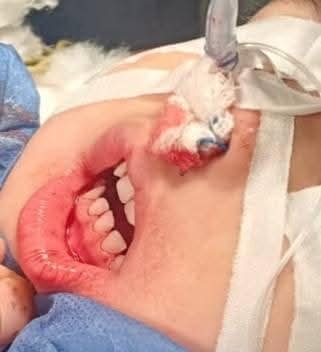 أثناء الجراحة