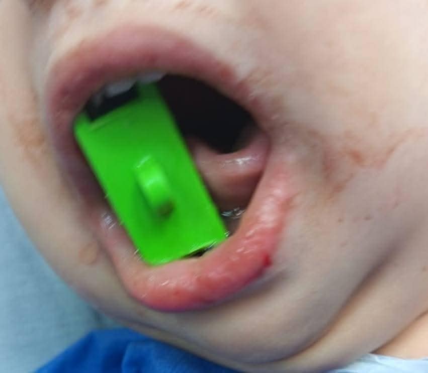 بعد الجراحة