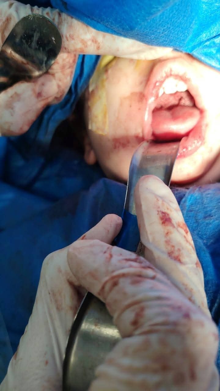 جانب من الجراحة