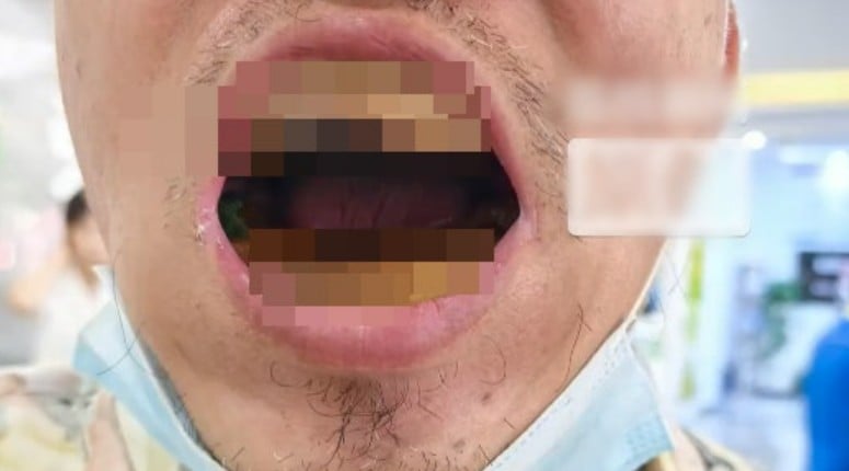 رجل يغير طقم أسنانه بنفسه لتوفير المال 