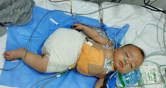صورة لطفل مبتور الرجل اليمنى