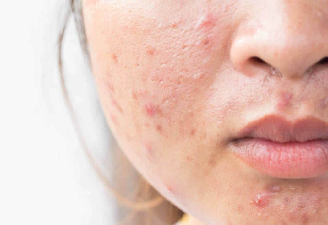 وصفات طبيعية للتخلص من ندبات حب الشباب وصفات طبيعية للتخلص من ندبات حب الشباب