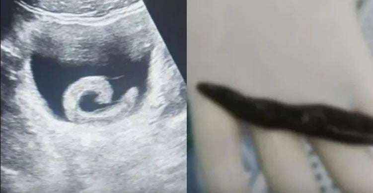 سبب غريب يدفع رجل لادخال علقة حية في مثانته