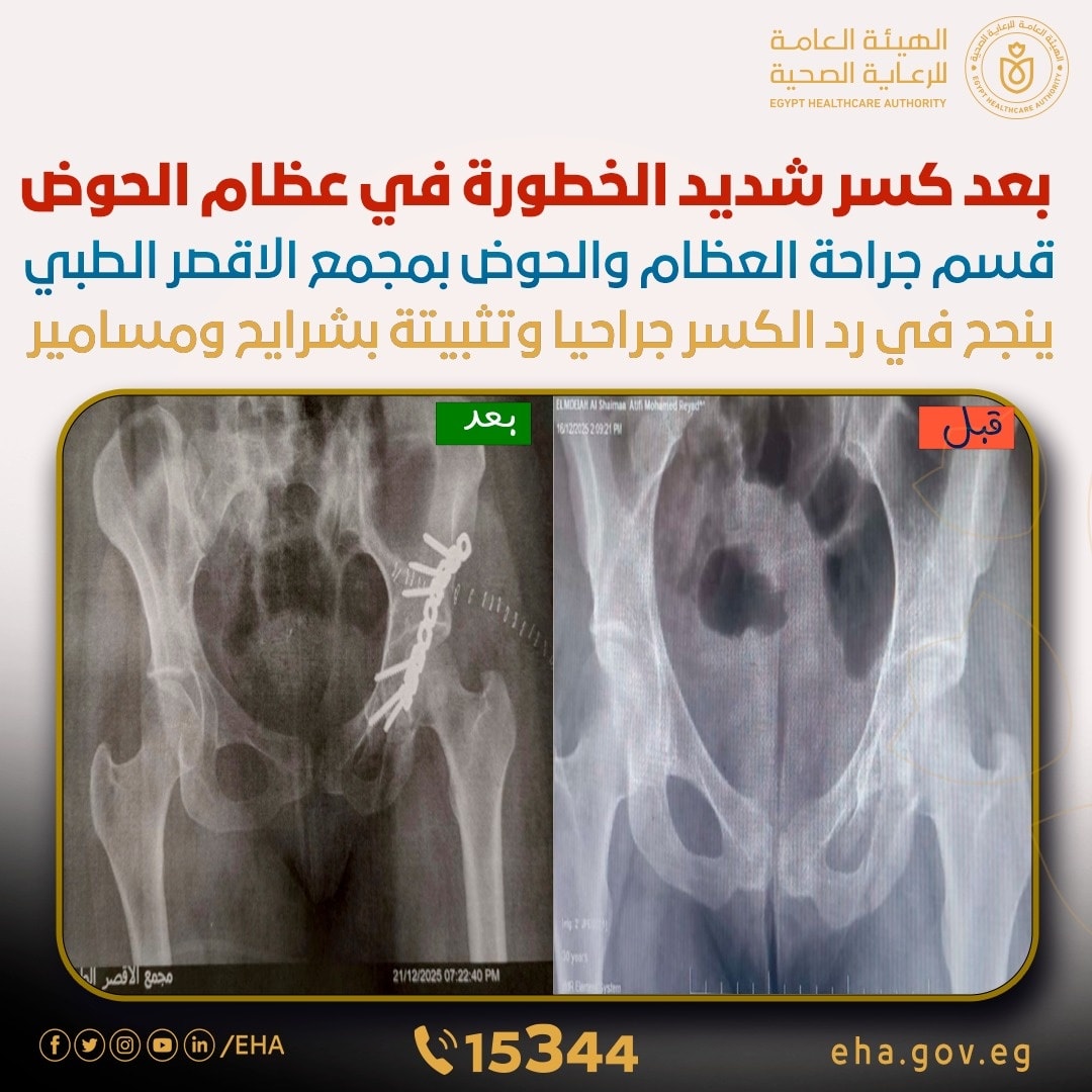 أطباء مجمع الأقصر الطبي ينجحون في رد مفتوح لكسر خطير في عظام الحوض