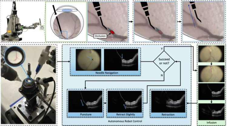 جراحة دقيقة فى العين