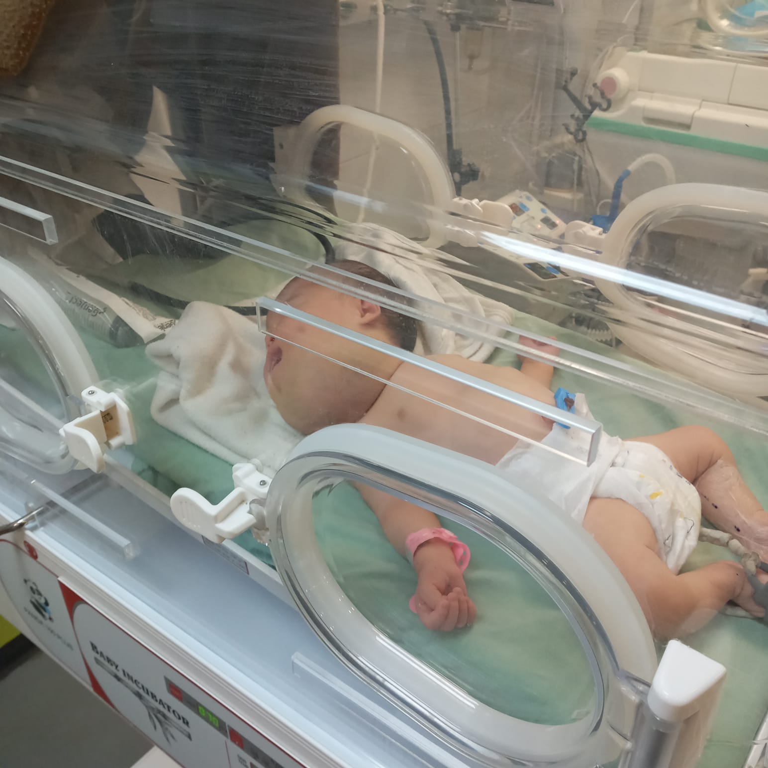 أنفاس معلقة بالحضانة.. حكاية حور العين قشطة وصراع رضيعة مع الموت فى قطاع غزة