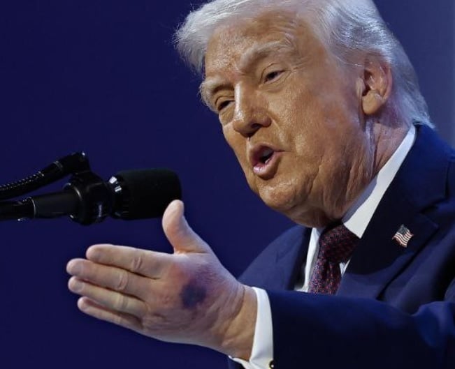 كدمة على يد ترامب كدمة على يد ترامب