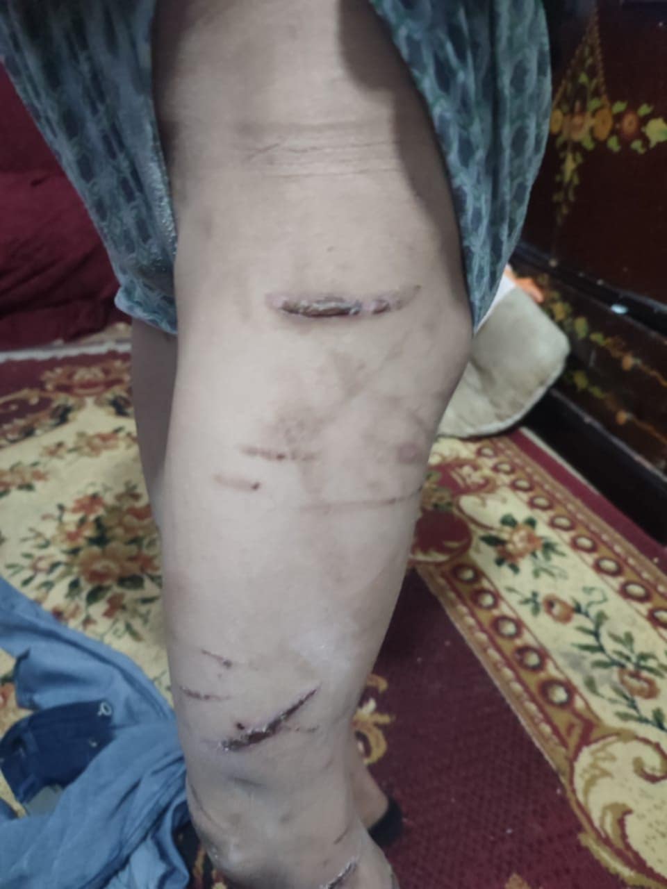 اثار التعذيب (2)