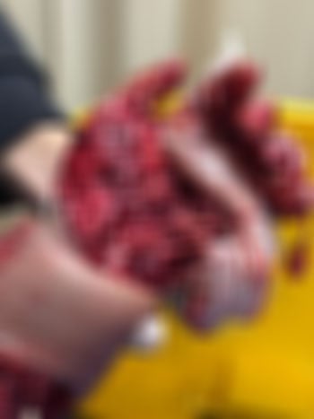 إجراء-تدخل-جراحي-بالغ-الدقة-والتعقيد