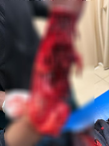 إنقاذ-ذراع-طفل-يبلغ-من-العمر-12-عامًا