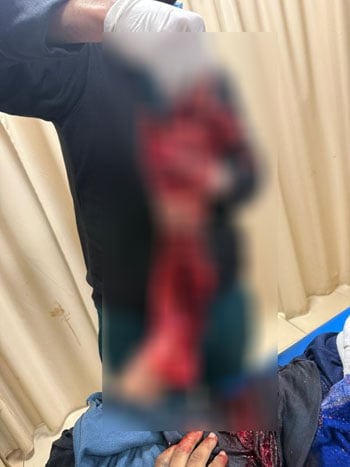 تهتك-كامل-بأنسجة-الذراع