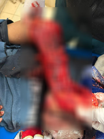 ثبيت-الكسور-الدقيقة-بالأصابع،-وتوصيل-الأوتار-والأعصاب-المصابة