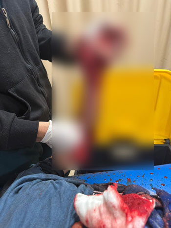 فريق-متعدد-التخصصات-ينقذ-ذراع-طفل-بعد-إصابة-مروعة-بطاحونة-قمح