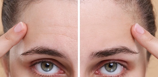 وصفات طبيعية للتخلص من تجاعيد الجبهة وصفات طبيعية للتخلص من تجاعيد الجبهة