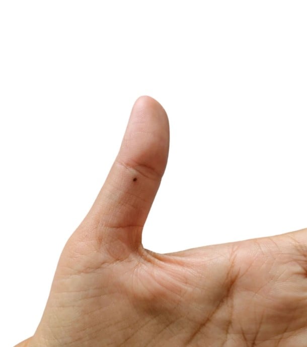 شامة على الأصبع