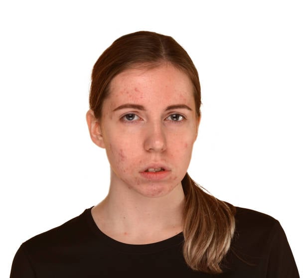 اخطاء تتسبب في تدمير البشرة اخطاء تتسبب في تدمير البشرة