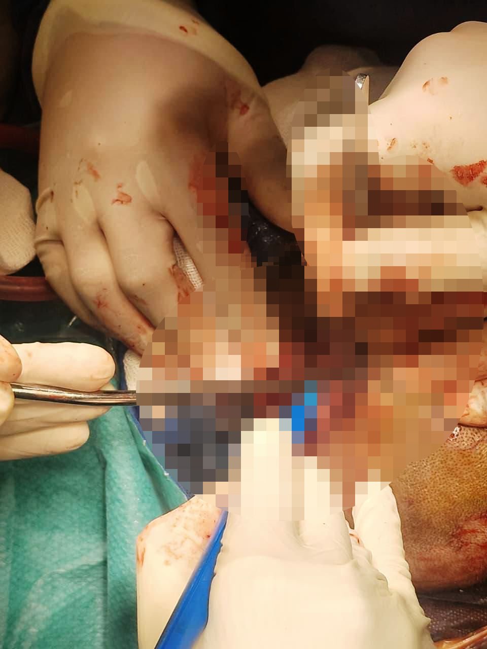 نجاح جراحة عاجلة لإنقاذ مصاب بآلة حادة نافذة بالمخ بمستشفى طوارئ قصر العينى (1)