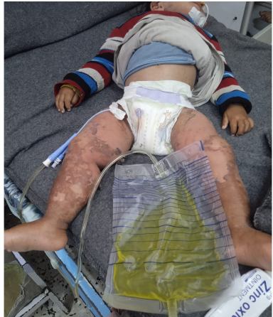 إصابات الطفل محمد زنون