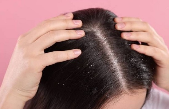 وصفات طبيعية لعلاج قشرة الرأس