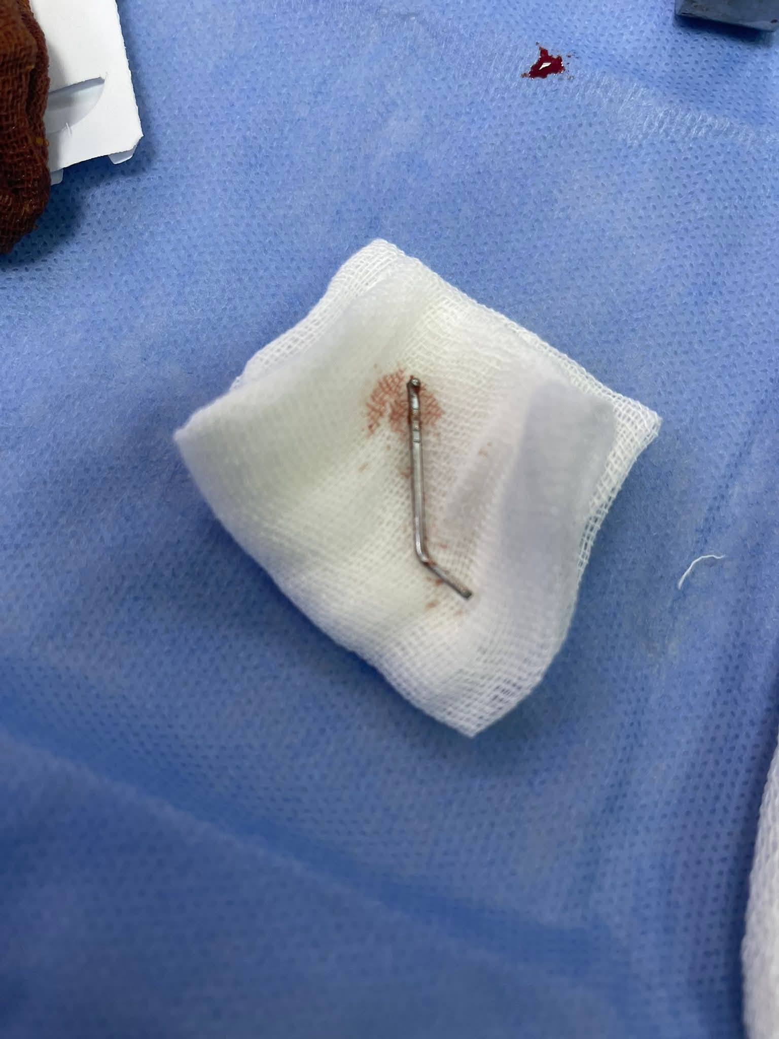 المسمار بعد استئصاله