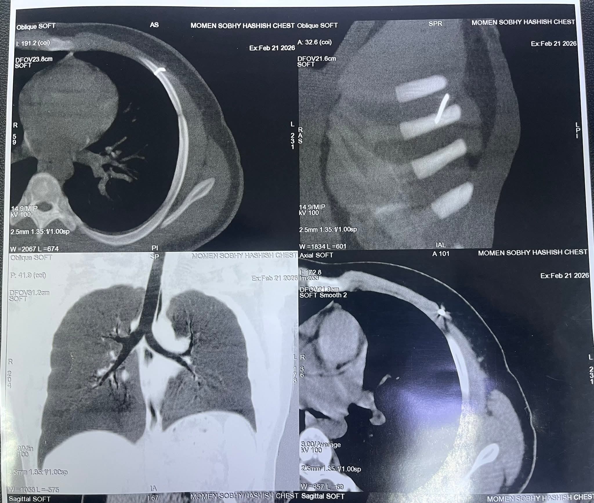 الأشعة توضح مكان المسمار
