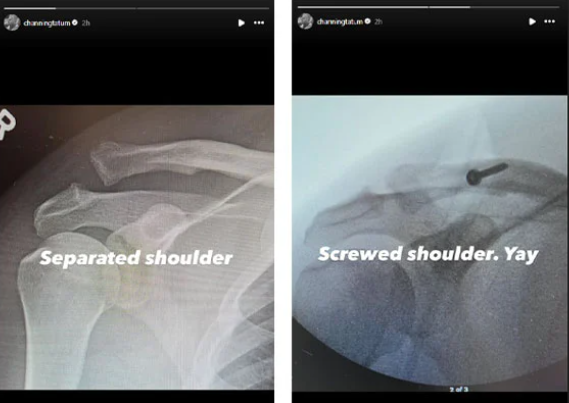 أشعة تشانينج تاتوم