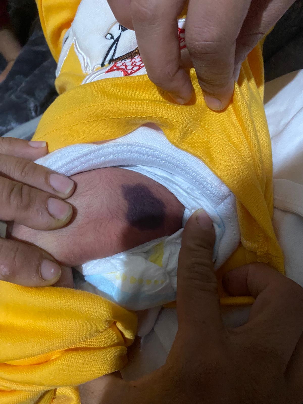 معاناة الطفلة غزل معاناة الطفلة غزل