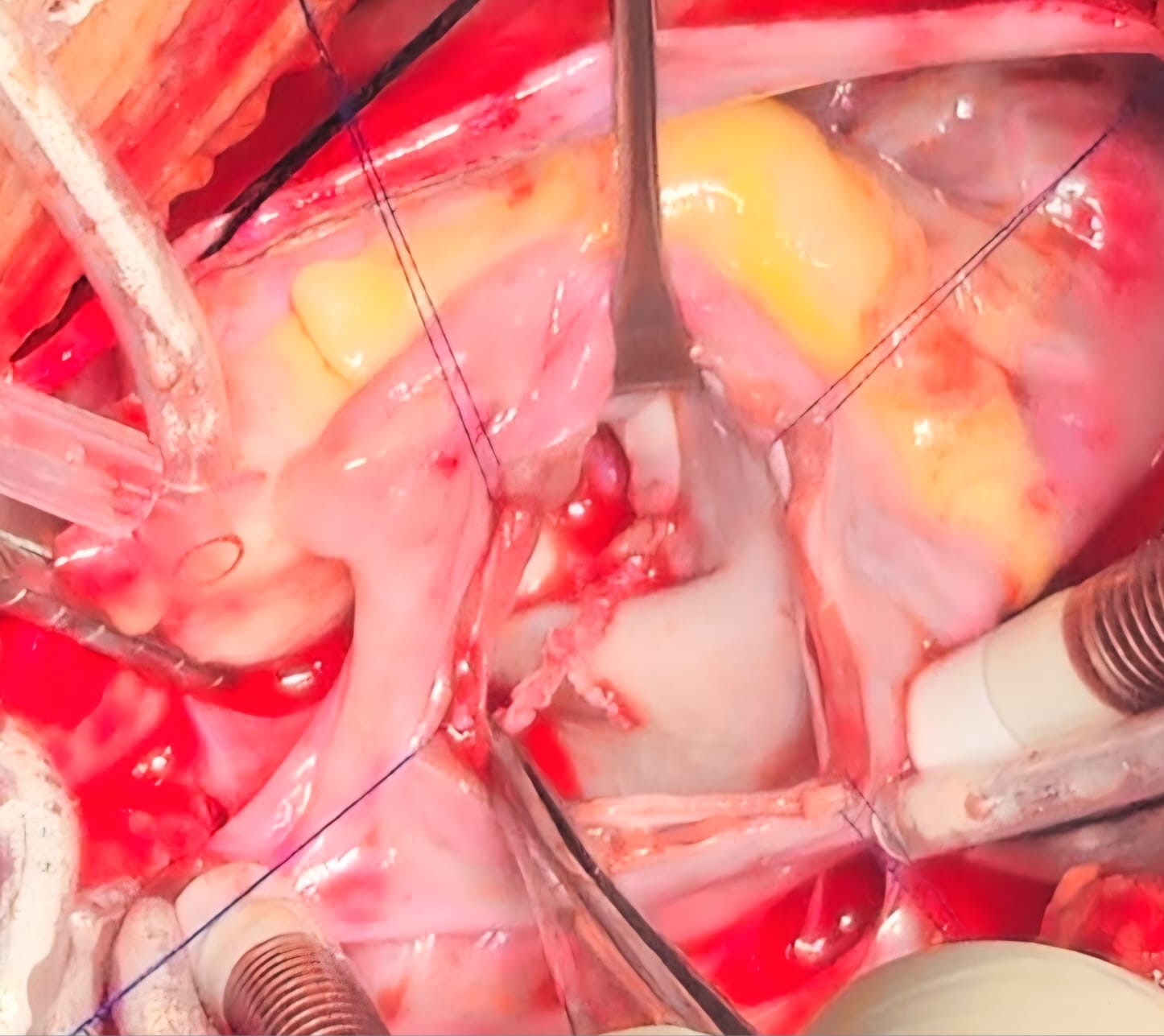 ورم نادر شديد الخطورة