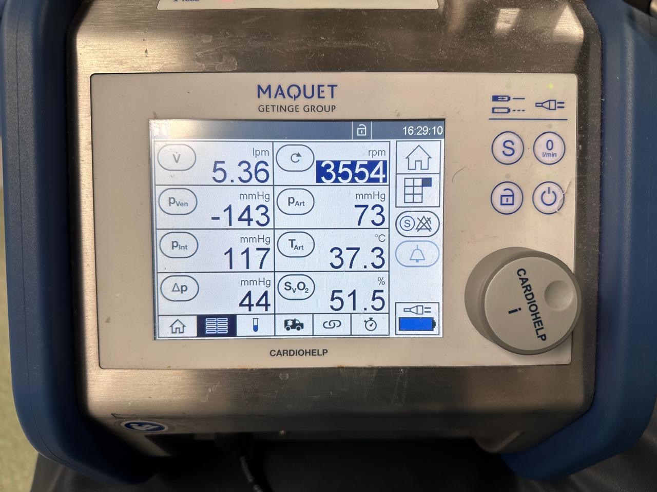 قصر العيني يعلن نجاح أول توصيل للإيكمو إلى الشريان الرئوي في مصر قصر العيني يعلن نجاح أول توصيل للإيكمو إلى الشريان الرئوي في مصر