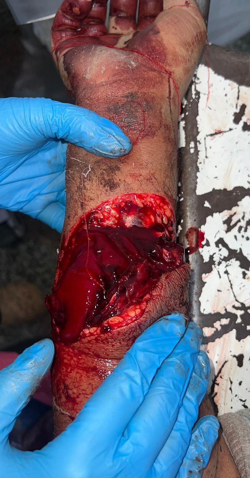 ذراع المصاب